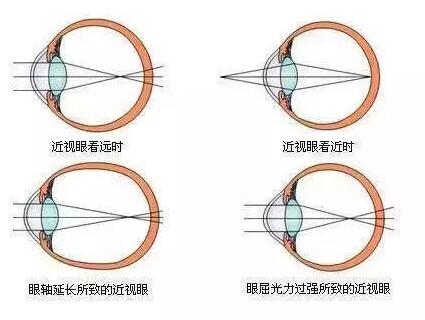 “小孩视力以前挺好的，没想到一个寒假下来就近视了。”昨天的8868 - 看球聊球追世界杯就来8868体育有限公司官方网站小儿眼科门诊里，很多家长都反应说，“孩子期末成绩不错，所以假期里对他的管束放松了，一有空就拿起手机玩。直到前几天，他嚷着看东西变模糊了，才带孩子来医院检查，检查结果是左右眼出现不同程度的近视，医生建议配戴眼镜。.jpg
