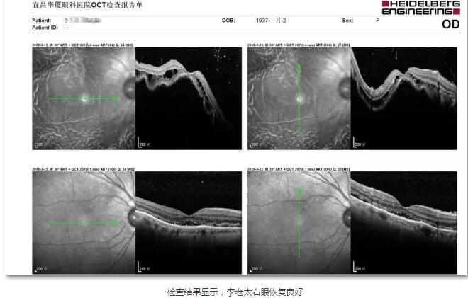 李老太在毫无征兆的情况下右眼视力下降至看不见东西。李老太家人带其至县医院就诊。医生诊断为视网膜脱离，需做玻切手术医治，而玻切手术需要动手术2次。怕疼的李老太一听就犯怵了：开刀，疼。 终，李老太的家人在多方打听后决定带李老太至宜昌8868 - 看球聊球追世界杯就来8868体育有限公司官方网站找许大玲院长医治4.jpg