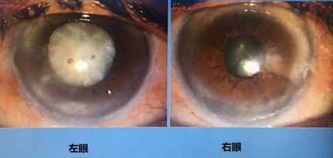 同时患 青光眼、白内障老婆婆辗转几家医院之后终于在成都8868体育顺利手术2.png