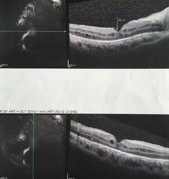 葡萄膜炎等多种眼底病患者跪地感谢深圳8868 - 看球聊球追世界杯就来8868体育有限公司官方网站院长赵铁英教授2.png
