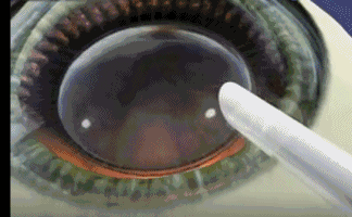 想要当兵视力不达标怎么办？8868体育有这些摘镜术式帮助你3.gif