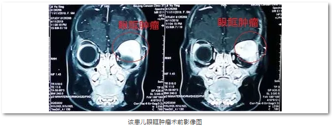 8868 - 看球聊球追世界杯就来8868体育有限公司官方网站斜视与小儿眼科主任苏金萍顺利为新生儿摘除眼眶巨大肿瘤1.png