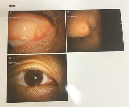 成都8868体育罗清礼院长为四处求医未果的河南眼眶肿瘤患者手术2.png