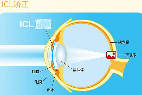 近视无法根治？但你可以这样做？8868体育“有爱就有希望”近视手术火热进行中8.png