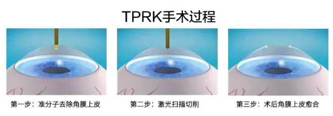 2021年征兵时间已定，参加征兵近视青年需尽快做近视手术3.png